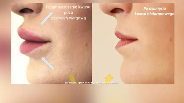Przed i po usunięciu kwasu hialuronowego z ust. Pokazuje efekt powiększania ust metodą na płasko i jego cofnięcie.