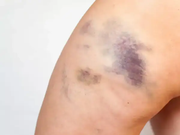 Große, schnell blaue Flecken auf dem Bein einer Frau nach einem Sturz.