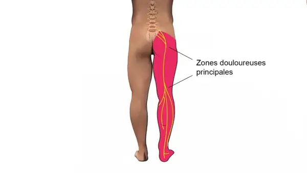 Schéma montrant les zones douloureuses principales d'une jambe, suggérant un mal aux cuisses la nuit.