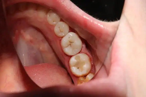 Boca con molares empastados, mostrando la importancia de la prevención de caries para mantener una sonrisa sana.