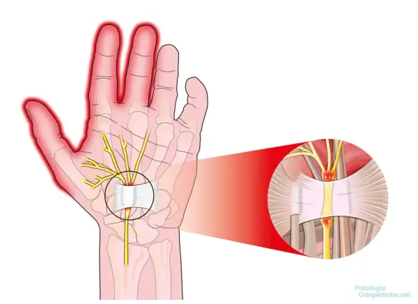 Illustrazione anatomica del tunnel carpale con nervo compresso, causa di scosse alle mani.