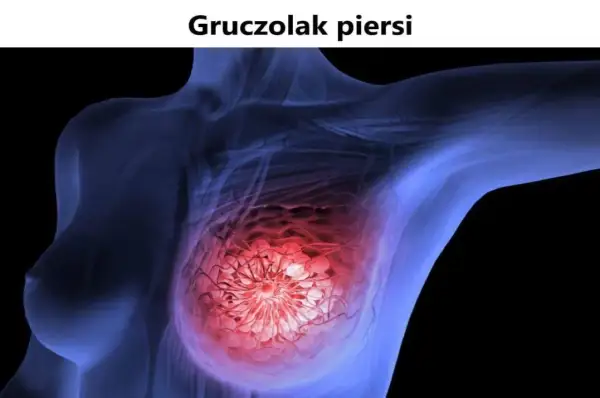Ilustracja przedstawia schemat piersi z widocznym gruczolakowłókniakiem, zaznaczonym na czerwono.