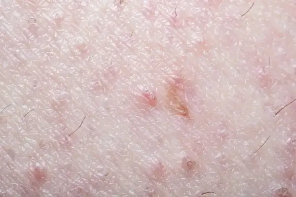 Gros plan sur la peau du pubis, montrant des rougeurs et des poils incarnés, signe d'une irritation cutanée.