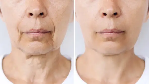 Comparación de piel: antes y después de un tratamiento que podría afectar el "ozempic face", mostrando reducción de arrugas y flacidez.