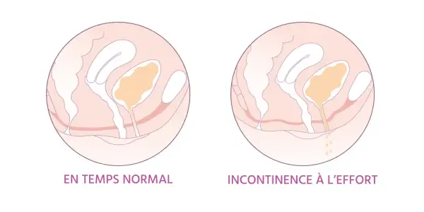 Schéma comparant le périnée féminin normal et en cas d'incontinence à l'effort. L'irritation périnée femme peut être liée à ces fuites.