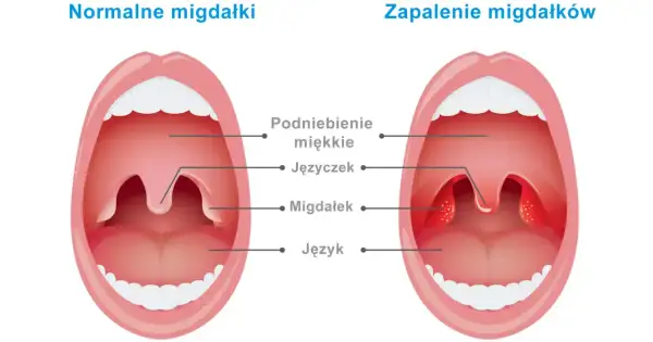 Migdałki NFZ: Jak skrócić kolejkę? Znajdź termin w kilka dni!