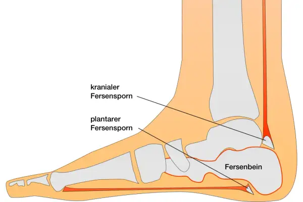 Schematische Darstellung der Calcaneus Anatomie mit Fersensporn (kranial und plantar) und dem Fersenbein.