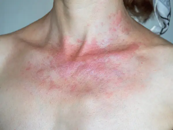 Rote, juckende Haut am Dekolleté und Hals, ein Zeichen für Sonnenallergie. Vorbeugen ist wichtig.