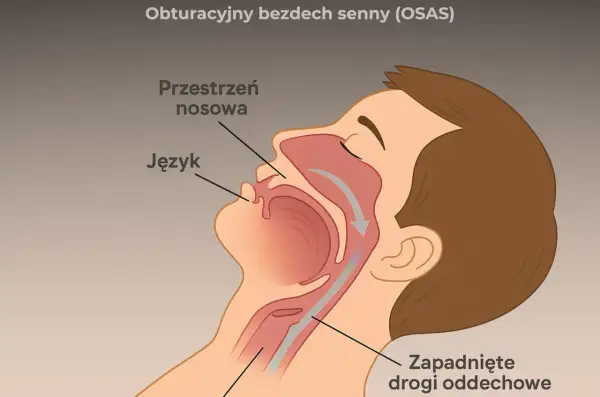 Bezdech senny: Jak rozpoznać, leczyć i dostać refundację CPAP?