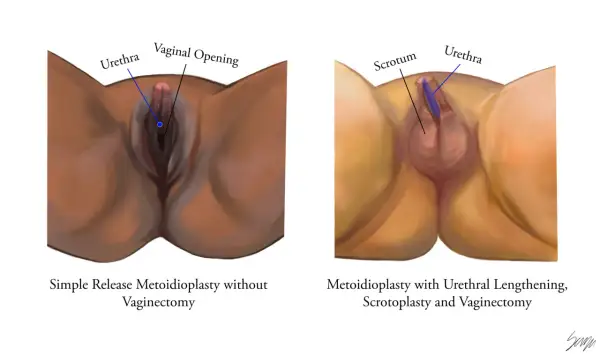 Comparaison de deux procédures chirurgicales pour transformer un pied mâle en femelle : la métoidioplastie simple et la métoidioplastie avec allongement urétral, scrotoplastie et vaginectomie.