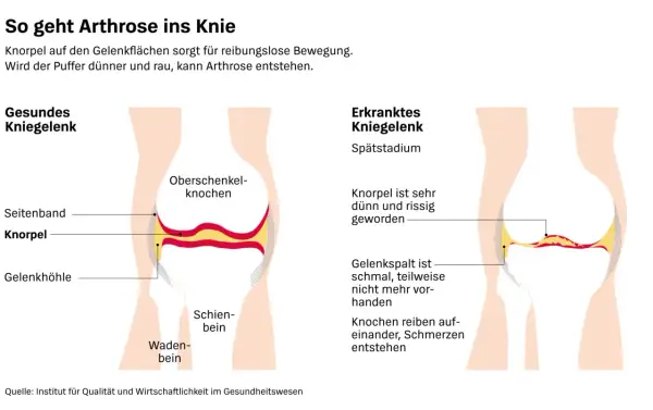 Vergleich von gesundem und arthrosekrankem Kniegelenk. Die Darstellung zeigt, wie Knorpelverschleiß zu Schmerzen führt – eine mögliche "wunderwaffe gegen arthrose knie" wäre hier wünschenswert.