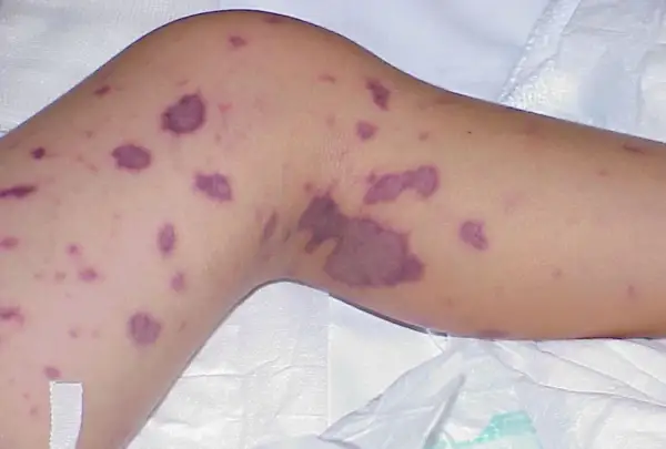 Piel con manchas moradas, un posible síntoma de meningitis.