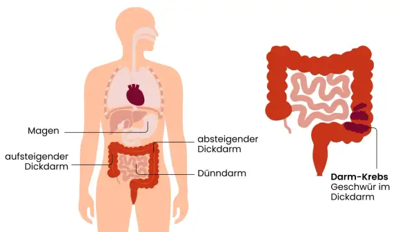 Illustration zeigt den menschlichen Verdauungstrakt mit einem hervorgehobenen Bereich, der Darmkrebs und Geschwüre im Dickdarm darstellt. Frühzeitige Erkennung von Darmkrebs Symptomen ist wichtig.