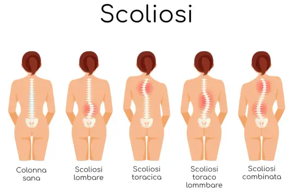 Illustrazione dei diversi tipi di scoliosi e dei relativi sintomi: colonna sana, scoliosi lombare, toracica, toraco-lombare e combinata.