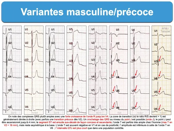 Variantes masculines/précoces : plusieurs tracés ECG montrant des variations de l'onde R et du segment ST, avec une transition précoce possible. Un ECG normal peut présenter ces caractéristiques.
