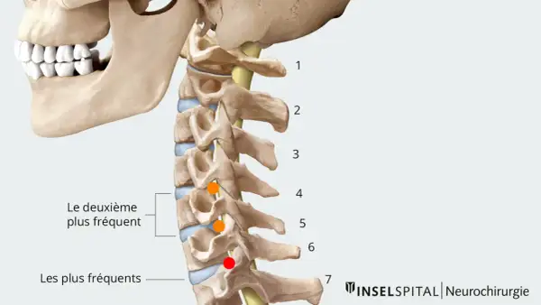 Anatomie du rachis cervical, montrant les localisations des hernies discales. Le temps de guérison d'une hernie cervicale dépend de sa gravité.
