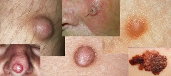 Hautveränderungen: Beulen, rote Flecken und dunkle Muttermale zeigen, wie schaut hautkrebs aus.