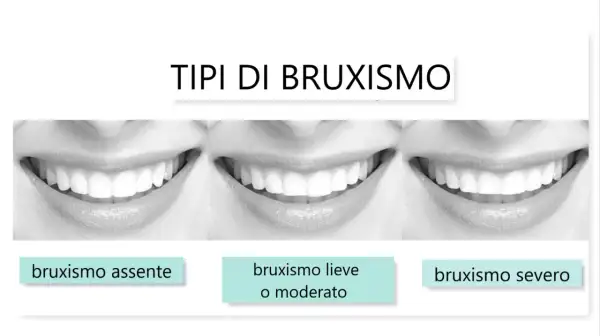 Tre immagini di sorrisi mostrano diversi gradi di bruxismo: assente, lieve/moderato e severo.