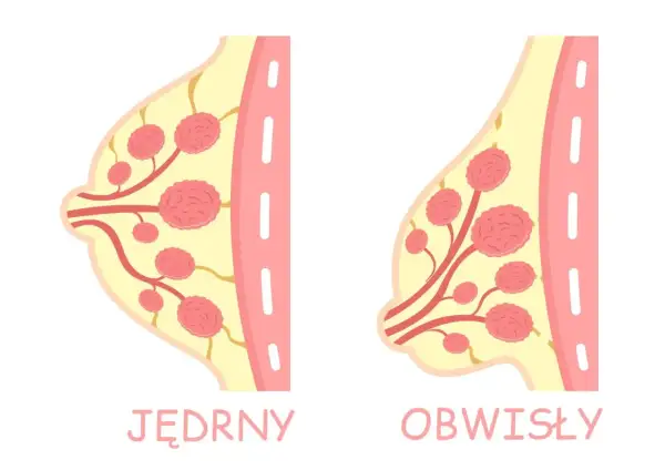 Ilustracja porównuje jędrny i obwisły biust, pokazując różnice w jego strukturze. Szukasz domowych sposobów na ujędrnienie biustu?