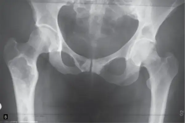 Czym jest ognisko osteolityczne? Przyczyny, objawy i diagnostyka zmian w kościach