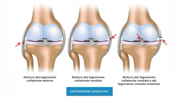 Illustrazione di ginocchia con lesioni ai legamenti: rottura collaterale esterno, mediale e combinata. Il dolore ai legamenti del ginocchio può variare.