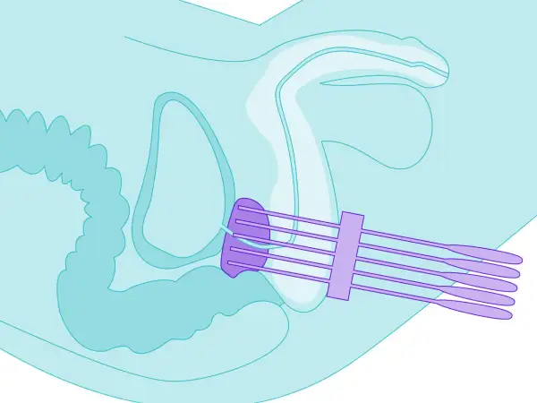 Illustration zeigt die Platzierung von Sonden für die Prostatakrebs-Strahlentherapie im Beckenbereich.
