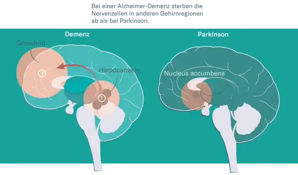 Gehirnschnitt zeigt Unterschiede bei Demenz und Parkinson. Bei Alzheimer-Demenz sterben Nervenzellen im Grosshirn und Hippocampus ab.
