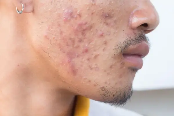 Visage d'un homme avec de l'acné. Une solution à base de rétinoïdes médicament pourrait aider à traiter ces imperfections.