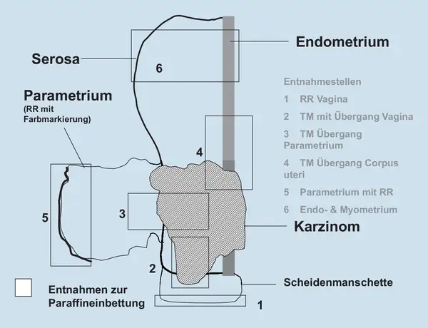 Schema zur Entnahme von Gewebeproben bei Zervixkarzinom. Markiert sind Serosa, Parametrium, Endometrium und Entnahmestellen.