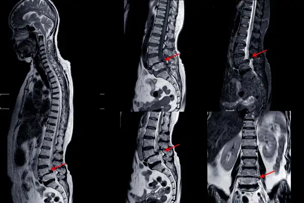 Badanie MRI kręgosłupa z widocznym uciskiem na korzenie nerwowe, wskazującym na rwa udowa. Czerwone strzałki podkreślają problem.