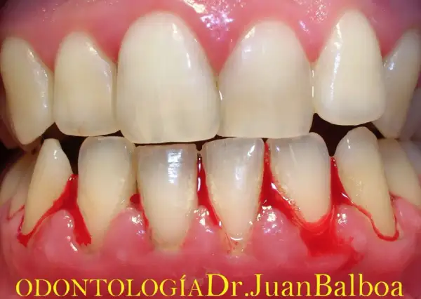 Encías inflamadas y sangrantes, un claro signo de gingivitis. La salud bucal es importante.