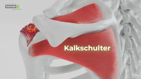 Kalkschulter: Ablagerungen im Schultergelenk. Was tun? Hier sehen Sie die Darstellung einer schmerzhaften Kalkschulter.