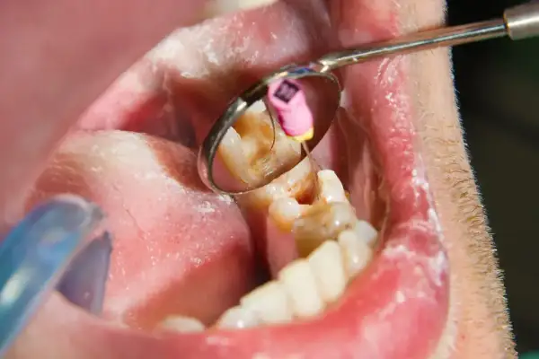 Widok jamy ustnej z lustrem dentystycznym, ukazującym ząb z widocznym stanem zapalnym, sugerującym nieleczony ropień zęba.