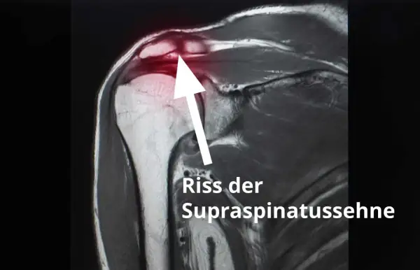 MRT-Aufnahme zeigt Riss der Supraspinatussehne. Erfahrungen mit Schulter-OP nach Sehnenriss.