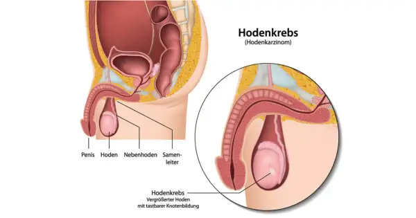 Anatomische Darstellung des männlichen Beckens mit Fokus auf den Hoden. Ein vergrößerter Hoden mit tastbarer Knotenbildung zeigt Hodenkrebs Symptome.