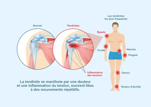 Illustration montrant une épaule normale et une épaule enflammée, avec les zones courantes de tendinites. Pour comment éviter tendinite, il faut comprendre l'inflammation des tendons.