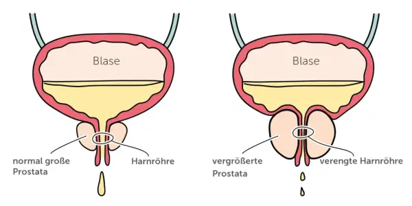 Vergleich von normaler und vergrößerter Prostata. Die vergrößerte Prostata kann zu verengter Harnröhre und damit zu Problemen beim Wasserlassen führen, ein mögliches Prostata Symptom.