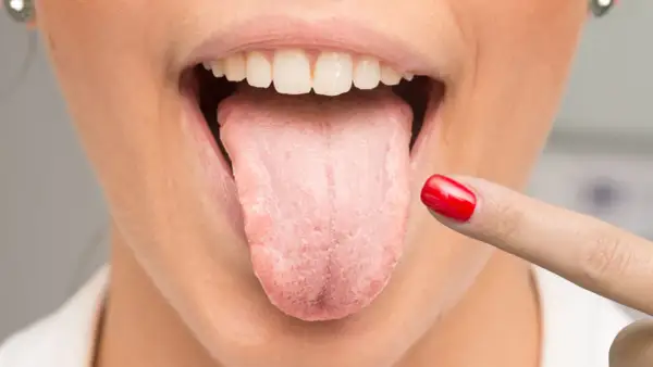 Dedo con uña roja señala lengua con aspecto blanquecino, sugiriendo la necesidad de un enjuague antifúngico.