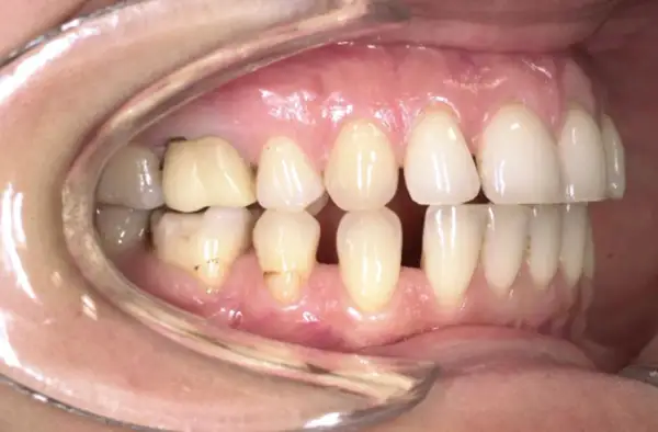 Denti con evidente overjet e overbite, alcuni incisivi superiori coprono quasi completamente quelli inferiori.