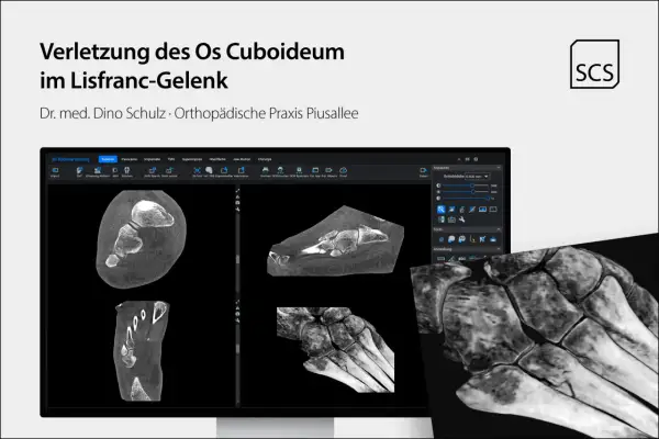 CT-Aufnahmen zeigen eine Verletzung des Os cuboideum im Lisfranc-Gelenk. Die Darstellung ermöglicht eine detaillierte Analyse der Knochenstruktur.