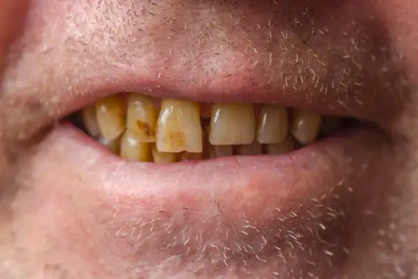 Primer plano de una boca con dientes amarillentos y manchas de esmalte.