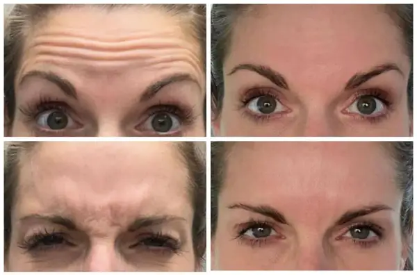 Vier close-ups van een voorhoofd met rimpels, die de effecten van botox tonen. Sommigen beweren dat botox slecht voor hersenen kan zijn.