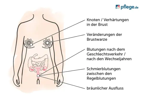 Anatomische Darstellung mit Hinweisen auf Symptome wie Knoten in der Brust, Blutungen und Ausfluss, die auf gynäkologische Probleme oder Blutkrebs aussehen könnten.