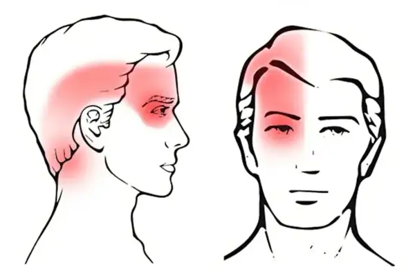 Illustrations de têtes montrant des zones rouges de douleur, suggérant des maux de tête cervicaux.