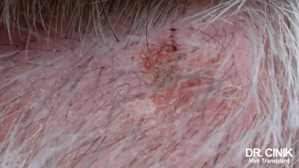 Gros plan sur un cuir chevelu sec et irrité, avec des squames et des rougeurs, suggérant une perte de cheveux.