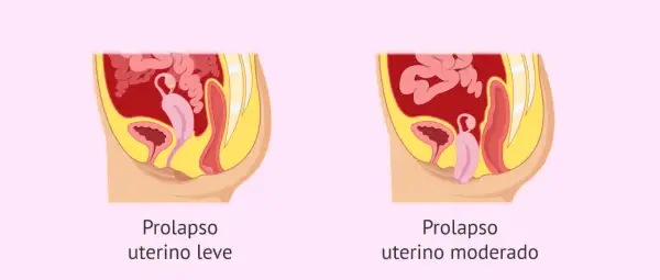 Ilustración comparativa de prolapso uterino leve y moderado, mostrando la posición del útero y órganos pélvicos.