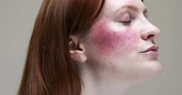 Rötliche Wangen bei Rosacea, ausgelöst durch Alkohol.