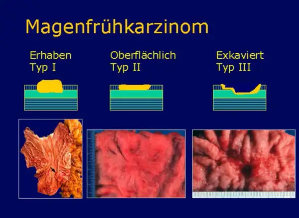 Magenkarzinom-Typen: Erhaben (Typ I), Oberflächlich (Typ II) und Exkaviert (Typ III). Bilder zeigen verschiedene Stadien eines pt2 tumor.