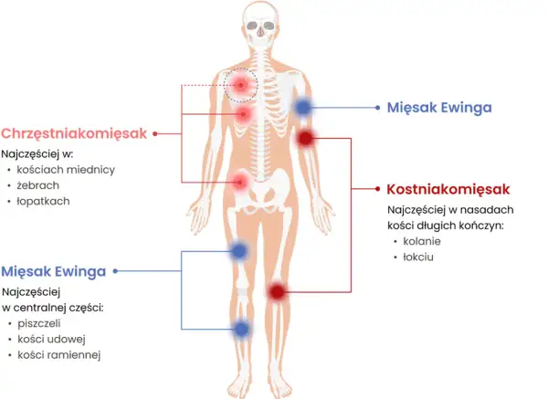 Schemat pokazuje lokalizację mięsaków kości: chrzęstniakomięsaka (czerwone punkty) w miednicy, żebrach, łopatkach; kostniakomięsaka (czerwone punkty) w nasadach kości długich; mięsaka Ewinga (niebieskie punkty) w piszczeli, kościach udowej i ramiennej.