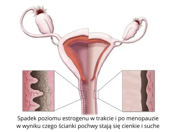 Spadek estrogenu powoduje suchość pochwy objawy: ścieńczenie i wysuszenie ścianek. Ilustracja pokazuje zmiany w narządach rodnych.